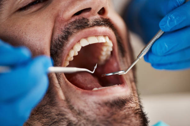 Best Knocked-Out Tooth (Avulsed Tooth) Treatment in Lakemont, PA